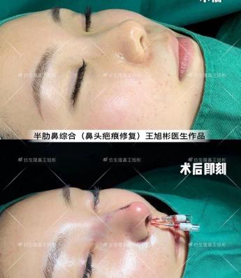 鼻骨内推多少钱（初鼻整形）