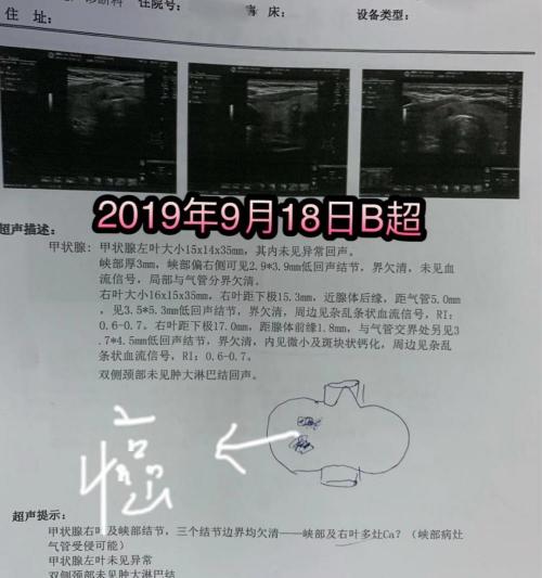 甲状腺b超多少钱（不同医院做的甲状腺B超结果会有差异吗）