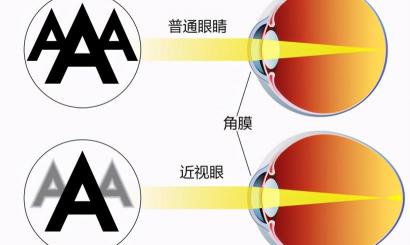 近视激光多少钱（关于）