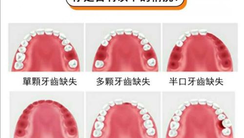 牙齿打桩要多少钱（什么是牙齿桩冠）