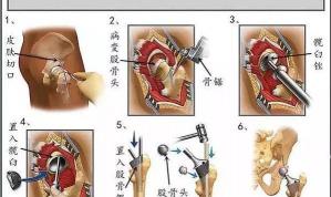 股骨头置换手术大概多少钱（股骨头置换手术是怎么回事）