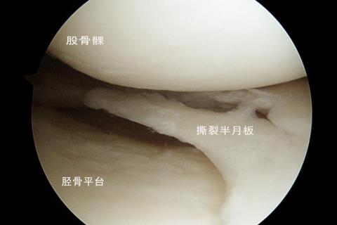 半月板微创手术多少钱（半月板撕裂微创手术后多久才能正常工作）