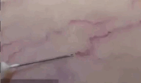 痔瘡硬化劑注射多少錢一針（神了）