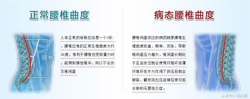 曲度腰椎治疗仪多少钱一台（腰椎间盘突出不要忽视腰疼）