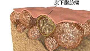 割一个脂肪瘤要多少钱（皮下脂肪瘤形成原因是什么）