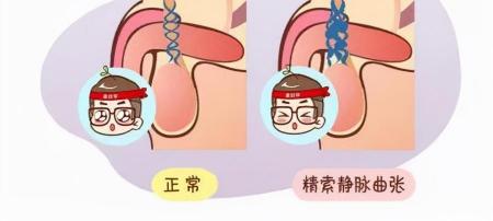 精索静脉曲张手术大概多少钱（精索静脉曲张何去何从）