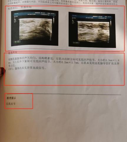 检查乳房彩超多少钱（看不懂乳腺彩超报告单）