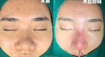纠正鼻中隔手术多少钱（案例合集）