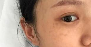 血府逐瘀丸多少钱一盒（脸上长斑）