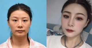 面部填充多少钱（33岁老阿姨做完自体脂肪面部填充60天）