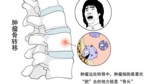 唑来膦酸多少钱一盒（骨转神针）