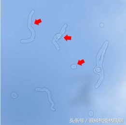 视网膜手术要多少钱（视网膜脱落呈年轻化趋势）