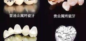装固定假牙多少钱（很纠结）