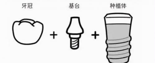 种植牙多少钱呢（北京房山一颗种植牙多少钱）