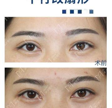双眼皮修复得多少钱（想做双眼皮修复一定不要着急）