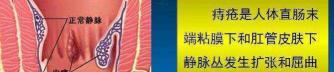 外痔疮手术多少钱（什么痔疮需要手术）