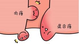 断痔膏多少钱一盒（肛门潮湿）