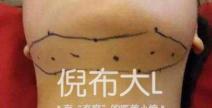 轮廓针多少钱一针（还以为轮廓针就是瘦脸针）