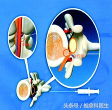 腰間盤(pán)突出做微創(chuàng)手術(shù)多少錢(qián)(腰突三)