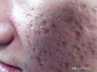 激光点阵多少钱一次（关于剥脱点阵激光修复痘坑的常见问题答疑）