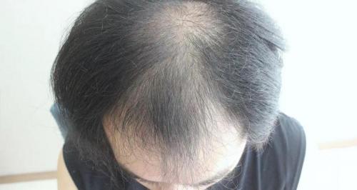 植发头发需要多少钱（27岁小哥5级脱发被叫大叔）