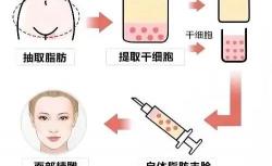 面部填充多少钱（可用于面部填充的材料都有哪些）