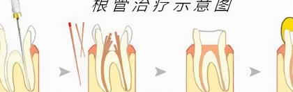 牙齿做根管多少钱（被根管治疗吓哭了）