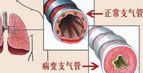 支气管激发试验多少钱（怀疑得了哮喘需要做哪些检查）