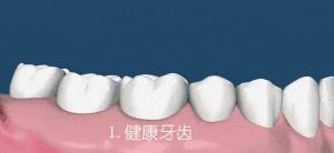牙龈萎缩怎么修复多少钱（牙龈萎缩牙齿松动有办法补救吗）