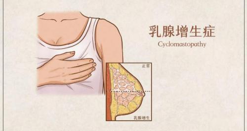 消乳散结胶囊多少钱一盒（乳腺增生这件事）