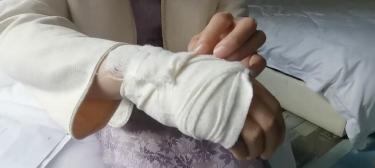 祛疤多少钱（淋浴室玻璃门突然碎了）