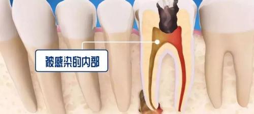牙齿开髓多少钱（牙疼后为什么医生建议你根管治疗而不是补牙）