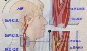 血管彩超检查要多少钱（中年男子患颈动脉斑块）