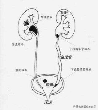 打尿结石一般多少钱（半夜在家被）