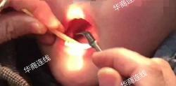 小孩做扁桃体手术需要多少钱（医生治幼儿扁桃体刺喉放血）