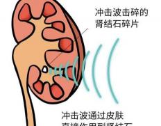 体外碎石需要多少钱（泌尿系统结石）