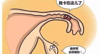 血hcg检查多少钱一次（现在这么多宫外孕）