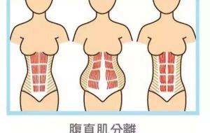 腹直肌修复多少钱（什么时候做产后腹直肌修复比较好呢）