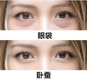 韩国做眼袋手术多少钱（卧蚕VS）