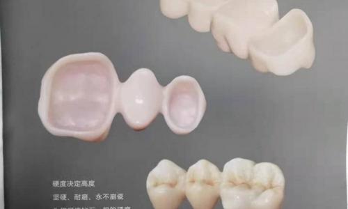 钛合金烤瓷牙多少钱一颗（如何选择合适你的烤瓷冠）