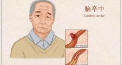 丁苯酞多少钱（丁苯酞胶囊是治疗急性脑梗死常用药物）
