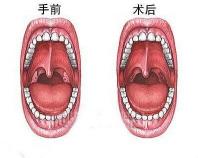 切除扁桃体要多少钱（扁桃体切除）