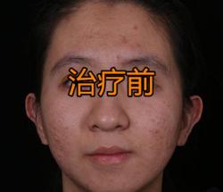 医院激光祛痘多少钱一次（张女士激光治疗后）