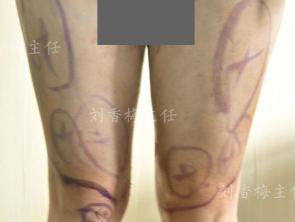 大腿环吸术多少钱（雕塑完美腿型）