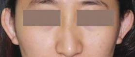 歪鼻矫正手术大概多少钱（一个歪鼻伤4个器官）
