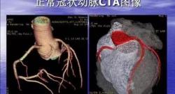 心脏ct多少钱（心脏做一个CT就能诊断冠心病心肌缺血）