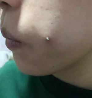 取钢钉手术费用多少钱（19岁女孩自愿在脸上打2颗钢钉）