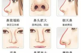 隆鼻一般多少錢（隆鼻整形）