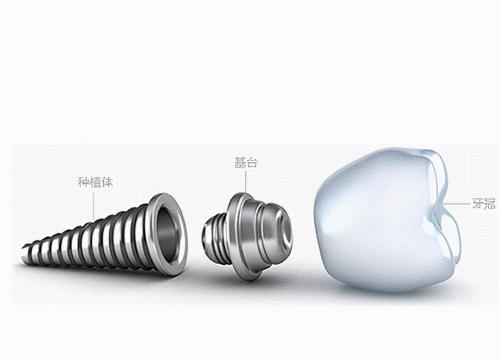 种植个牙多少钱（牙齿那些事儿）