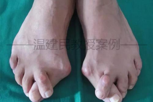 治疗大脚骨多少钱（大脚骨的痛你懂吗）